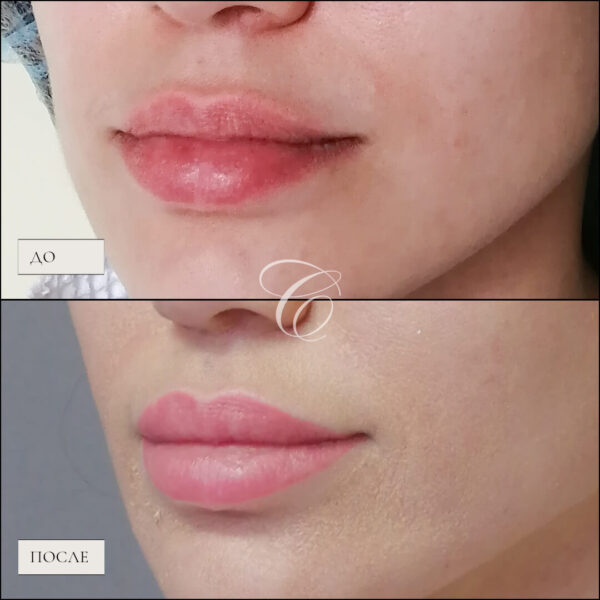 До и через 6 месяцев после увеличения верхней губы дермато-жировым лоскутом